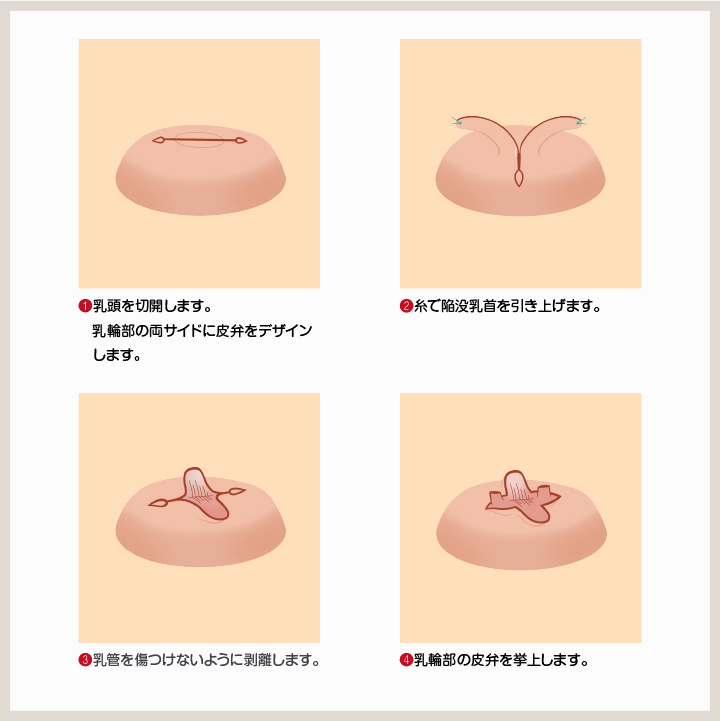 陥没　乳首 