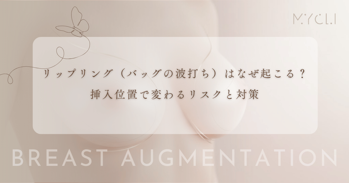 リップリング（バッグの波打ち）はなぜ起こる？挿入位置で変わるリスクと対策