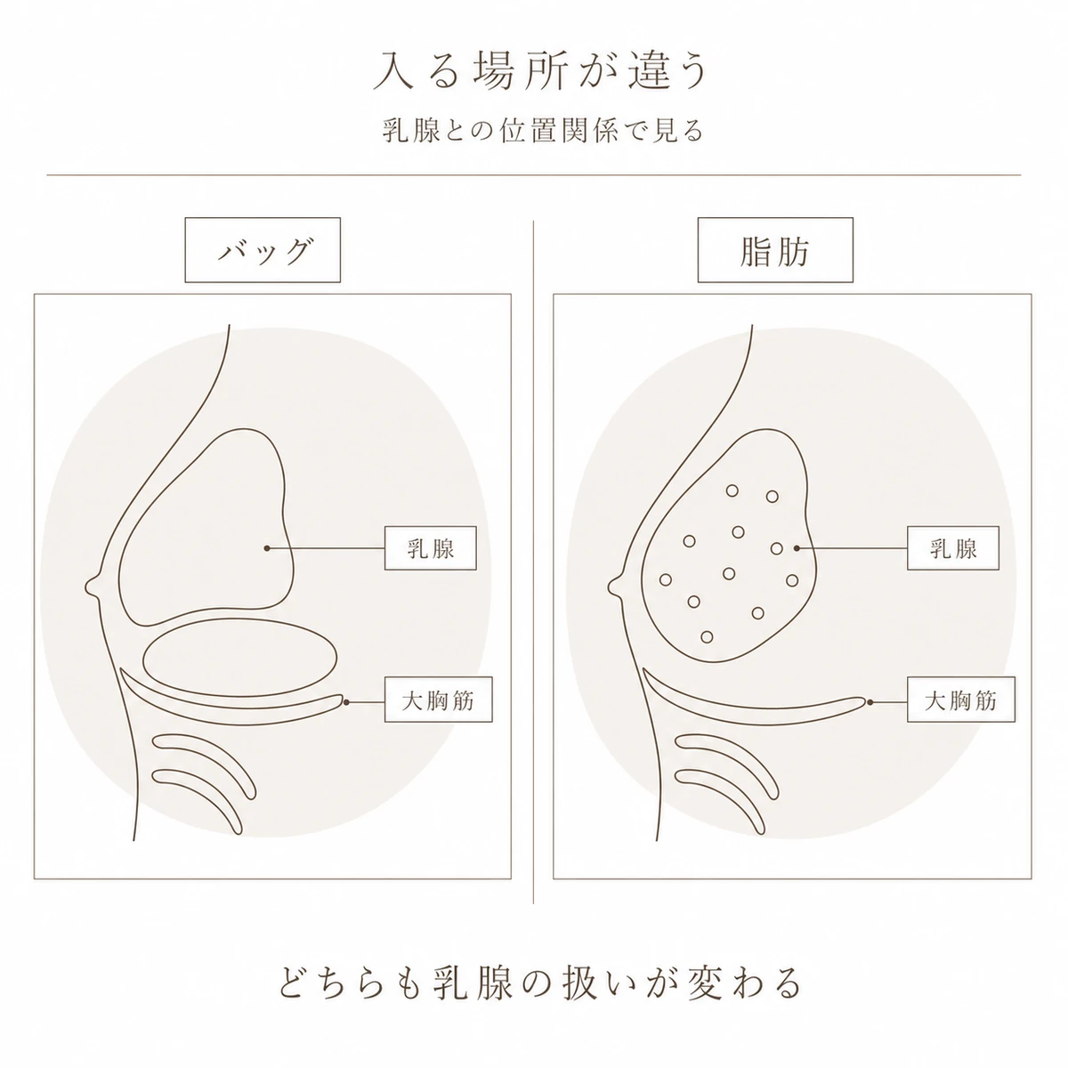 シリコンバッグと脂肪注入で挿入物が入る層の違いを胸部の断面で対比した図解